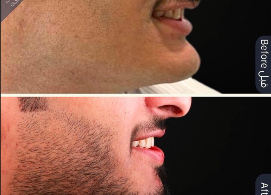 Before-and-after side-profile comparison focused on lower-face definition