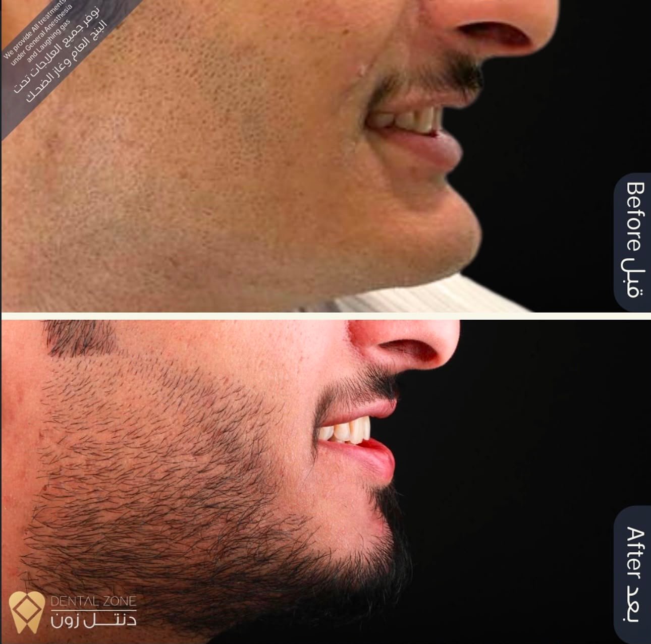 Before-and-after side-profile comparison focused on lower-face definition