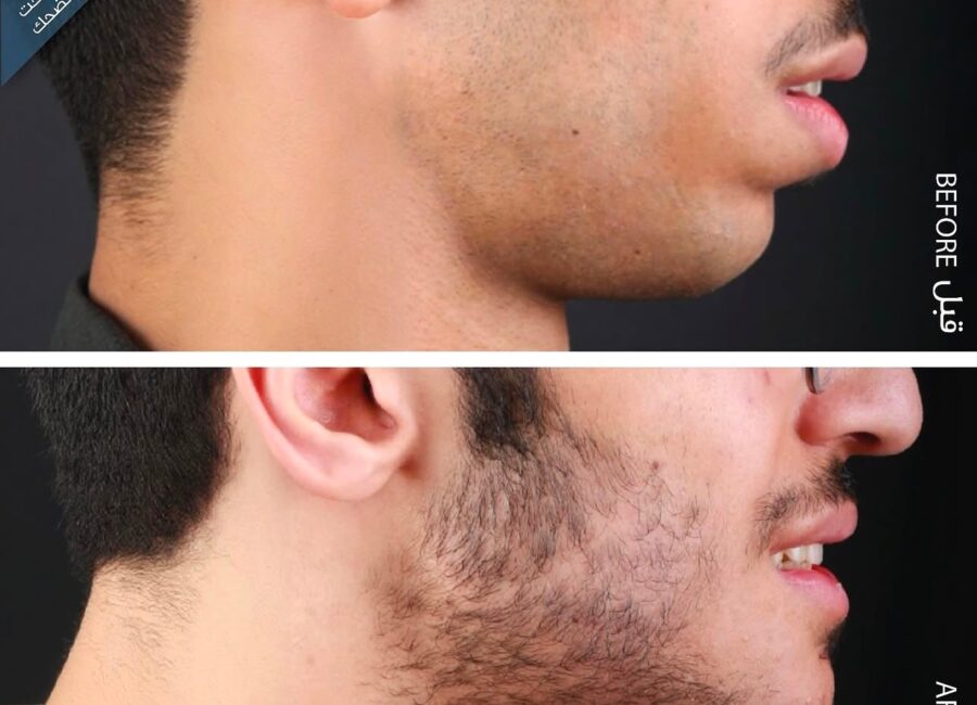 Before-and-after male side profile focused on chin and jawline balance