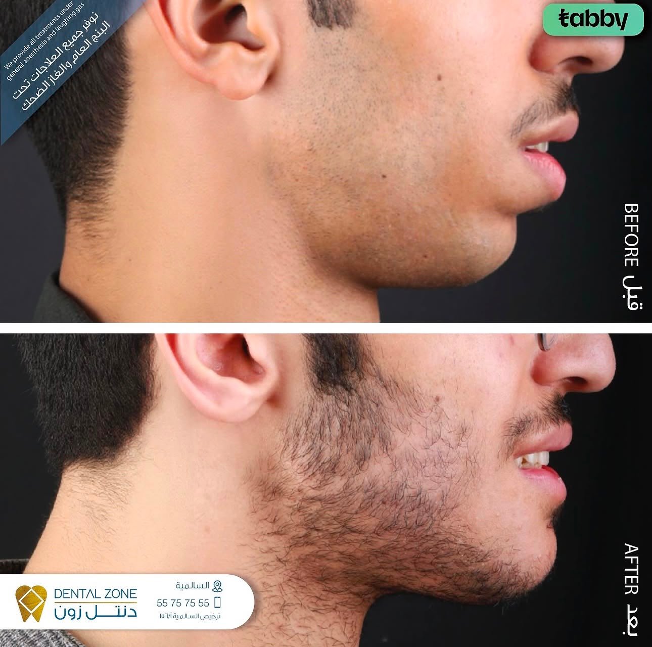 Before-and-after male side profile focused on chin and jawline balance