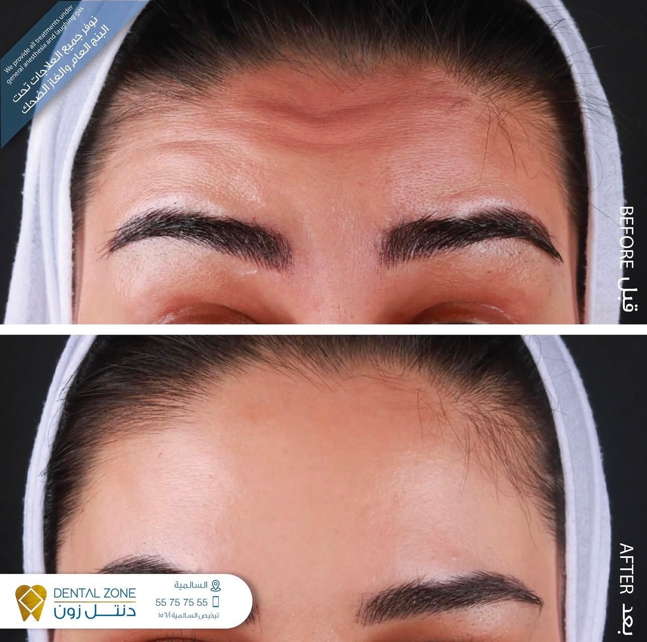 Before-and-after forehead comparison showing softened horizontal expression lines