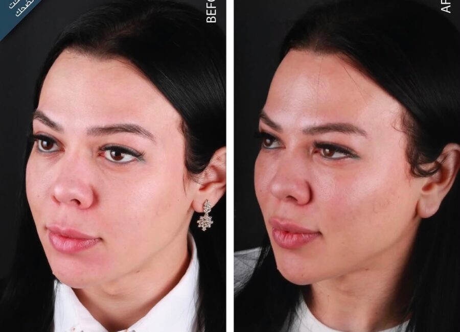 Before-and-after three-quarter portrait focused on overall facial balance