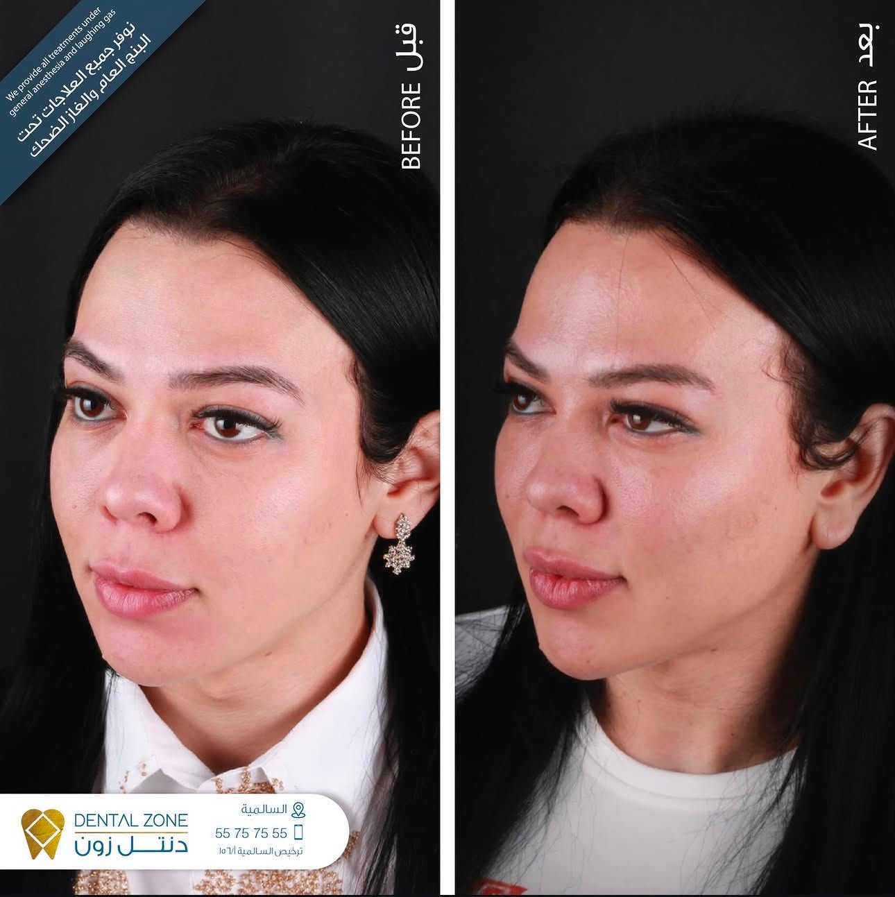 Before-and-after three-quarter portrait focused on overall facial balance