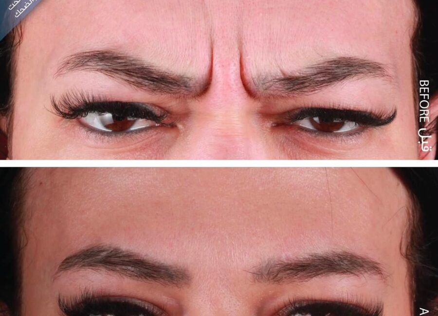 Before-and-after glabellar region showing softened frown lines