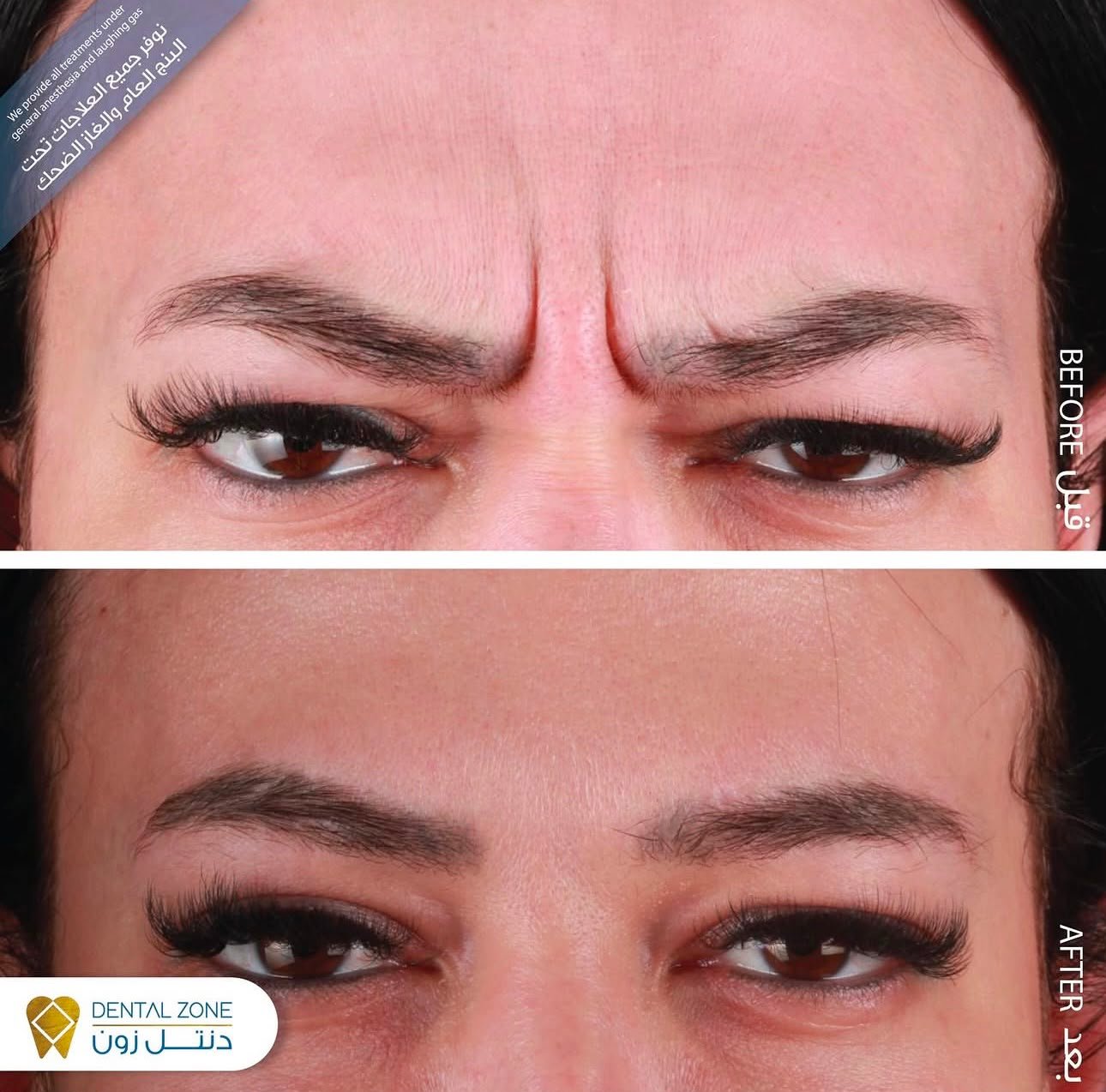 Before-and-after glabellar region showing softened frown lines