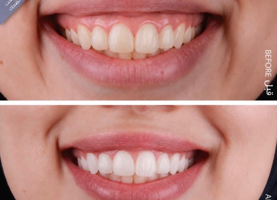 Before-and-after smile comparison showing reduced upper gingival display