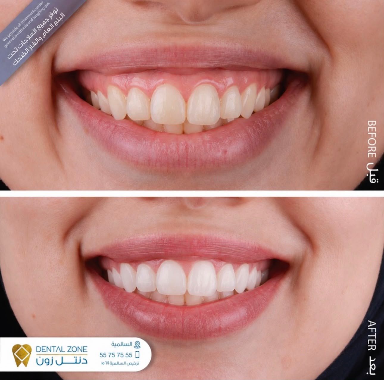 Before-and-after smile comparison showing reduced upper gingival display