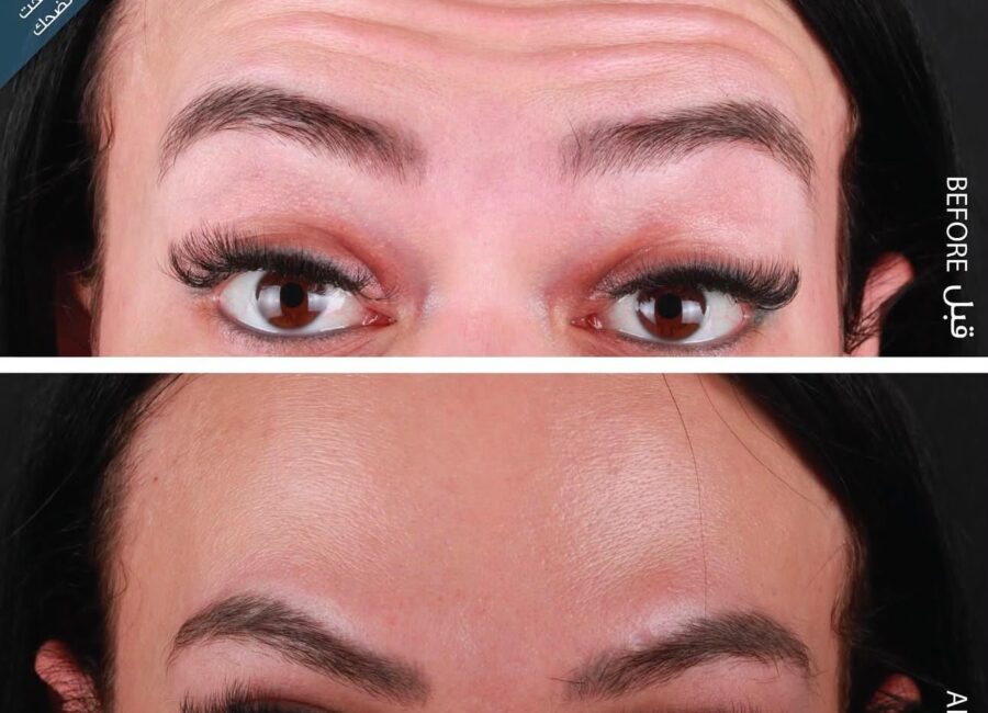 Before-and-after forehead comparison showing softened dynamic lines