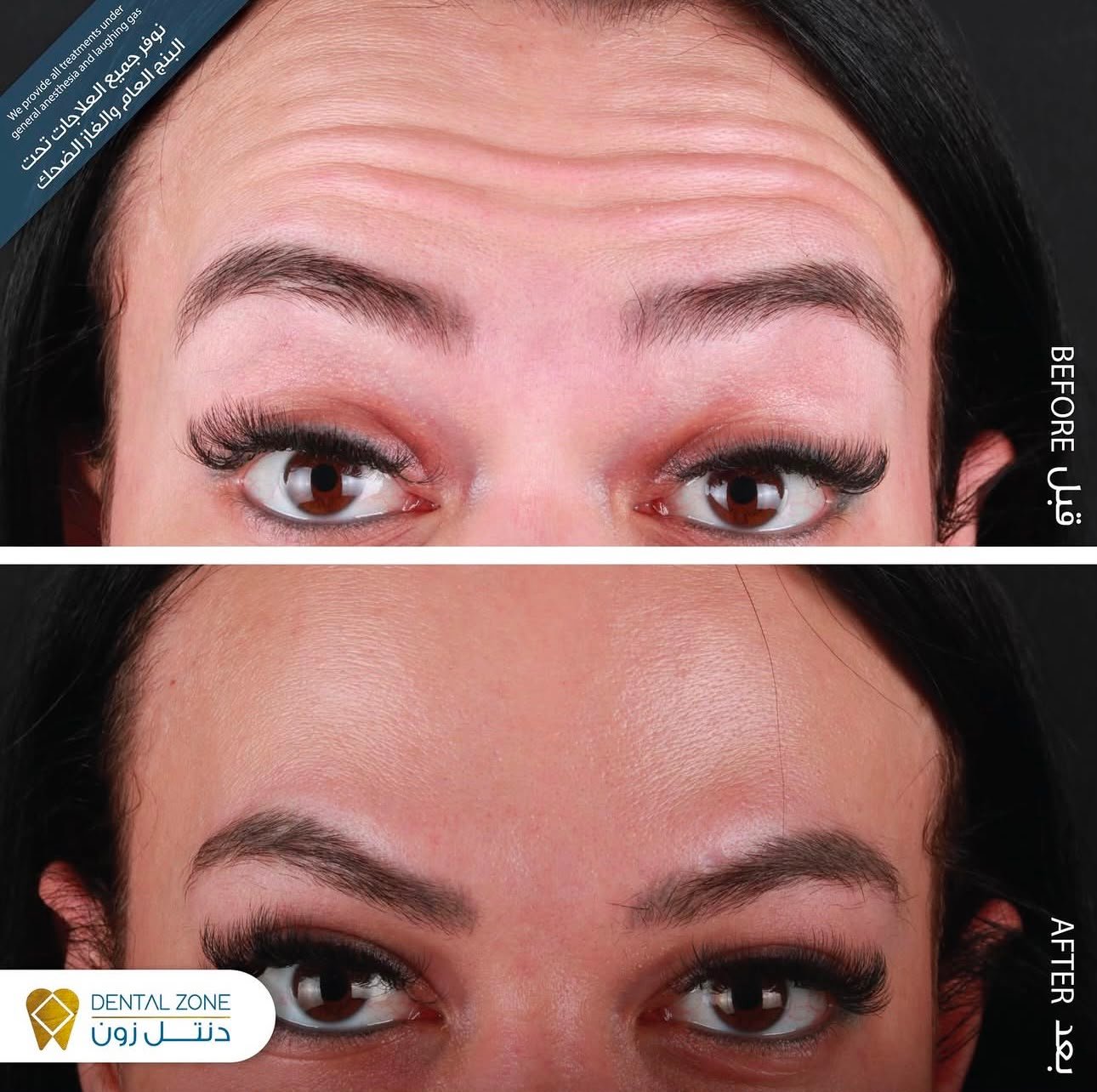 Before-and-after forehead comparison showing softened dynamic lines